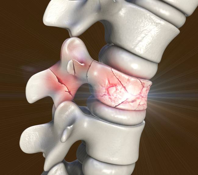 Ilustração da espinha dorsal humana com uma vértebra fraturada em várias partes, indicadas por rachaduras em vermelho