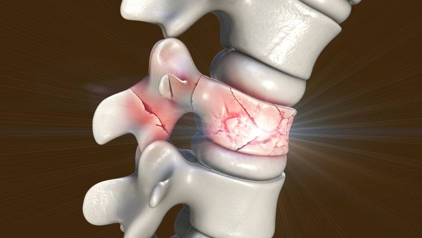 Ilustração da espinha dorsal humana com uma vértebra fraturada em várias partes, indicadas por rachaduras em vermelho