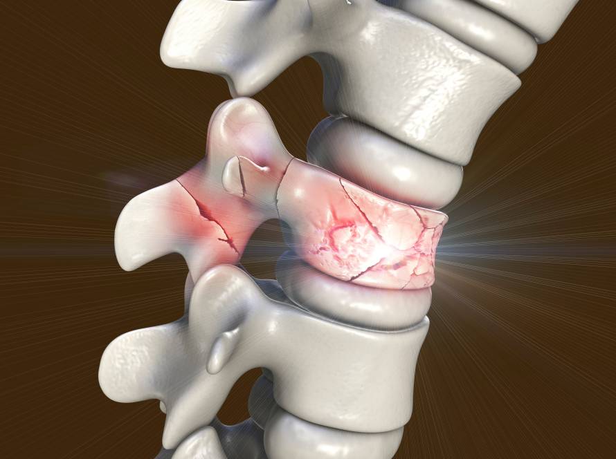 Ilustração da espinha dorsal humana com uma vértebra fraturada em várias partes, indicadas por rachaduras em vermelho